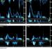 Abb. 3a-b: Pericarditis constrictiva