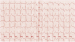 Abb. 3: EKG