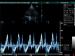 Abb. 5: Pericarditis constrictiva