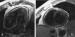 Abb. 6a-b: Pericarditis constrictiva