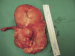 Aktuelles Bild - Abb. 2: Tumor - Appendix