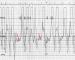 Abb. 7: Pericarditis constrictiva