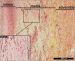 Abb. 1: Aortenaneurysma