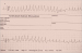 Aktuelles Bild - Abb. 1: EKG