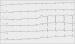 Abb. 1: Brugada-Syndrom - EKG