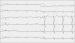 Abb. 2: Brugada-Syndrom - Ajmalin-Test