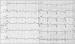 Abb. 3: Brugada-Syndrom - Ajmalin