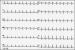 Abb. 1: Brugada-Syndrom