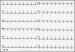 Abb. 2: Brugada-Syndrom