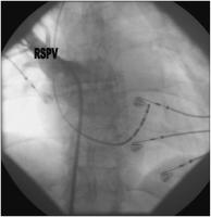 Abbildung 2: Pulmonalvenenangiographie