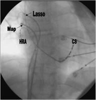 Abbildung 3: Pulmonalvenenangiographie