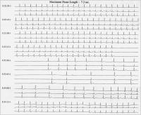 Abbildung 1: Sinusarrest - Karotis-Sinus-Syndrom