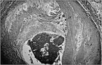 Abbildung 2: Akute Koronarsyndrome - Thrombusbildung - Plttchenaggregation