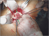 Abbildung 2: Aneurysma