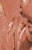 Abbildung 6: Prothese - A. mensenterica inferior 