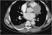Abbildung 8: Aorta-Dissektionsmembran