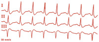 Abbildung 1: EKG