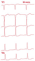 Abbildung 2: EKG
