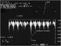 Abbildung 3: LVOT