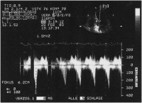 Abbildung 4: LVOT