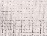 Abbildung 1: EKG