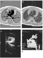 Abbildung 9a-d: Magnetresonanzangiographie, Arteria pulmonalis