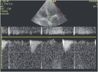 Abbildung 11: LVOT-VTI