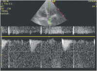 Abbildung 13: LVOT-VTI
