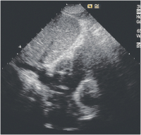Abbildung 17:  Vena cava inferior