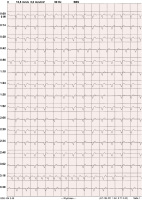Abbildung 1: EKG