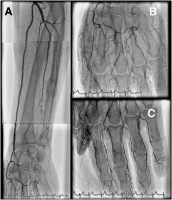 Abbildung 2a-c: Arteria radialis