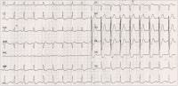 Abbildung 1: EKG