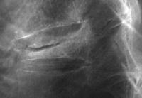 Abbildung 2: Pseudoarthrose