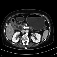 Abbildung 4: CT- Cholezystis