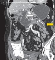 Abbildung 5: CT-Cholezystis - Ileus