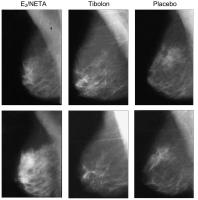 Abbildung 1: HRT- Mammogramm