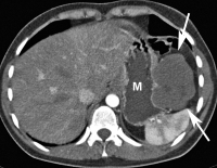 Abbildung 1A: Hydro-MDCT
