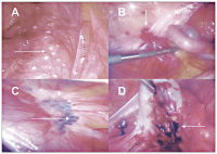 Abbildung 1: Endometriose