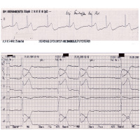 Abbildung 3: EKG-Beispiel