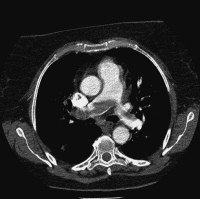 Abbildung 1: Pulmonalarterienembolie