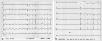 Abbildung 1a-b: EKG