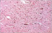 Abbildung 1a: ALS - Neuropathologie