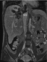 Abbildung 2b: MR-Angiographie