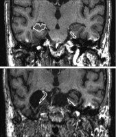 Abbildung 1: Alzheimer-Demenz