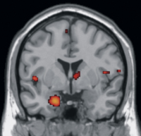 Abbildung 2: Alzheimer-Demenz