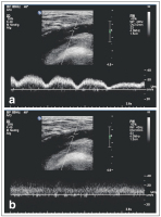 Abbildung 4a-b: Vena femoralis communis