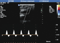 Abbildung 2: Arteria tibialis posterior