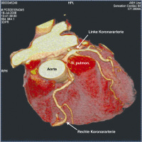 Abbildung 1: Arteria coronaria