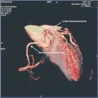 Abbildung 2: Arteria coronaria