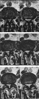 Abbildung 1a: Aperius PercLID-Spacer